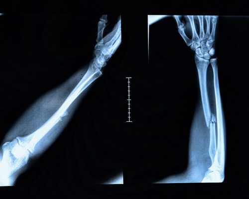 x-ray image show fracture of the radius bone