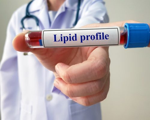 Cholesterol test or lipid profile test for detect dyslipidemia disease