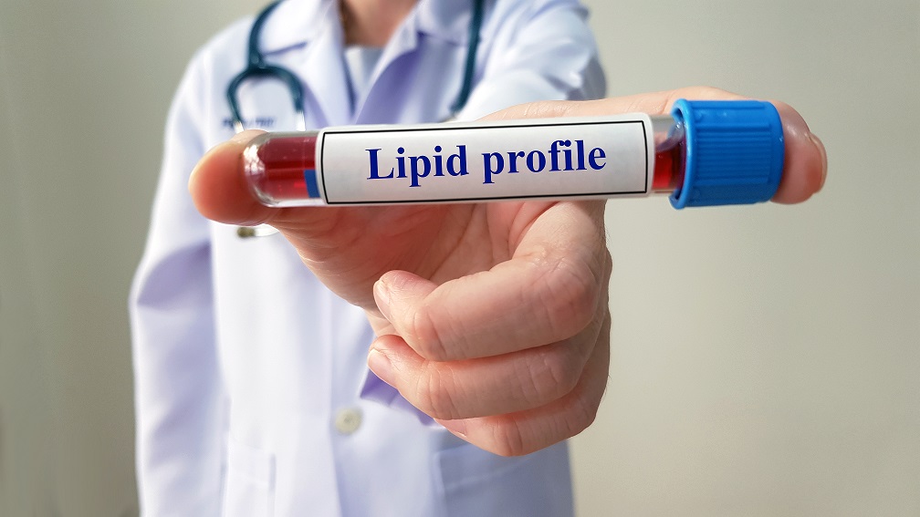 Cholesterol test or lipid profile test for detect dyslipidemia disease
