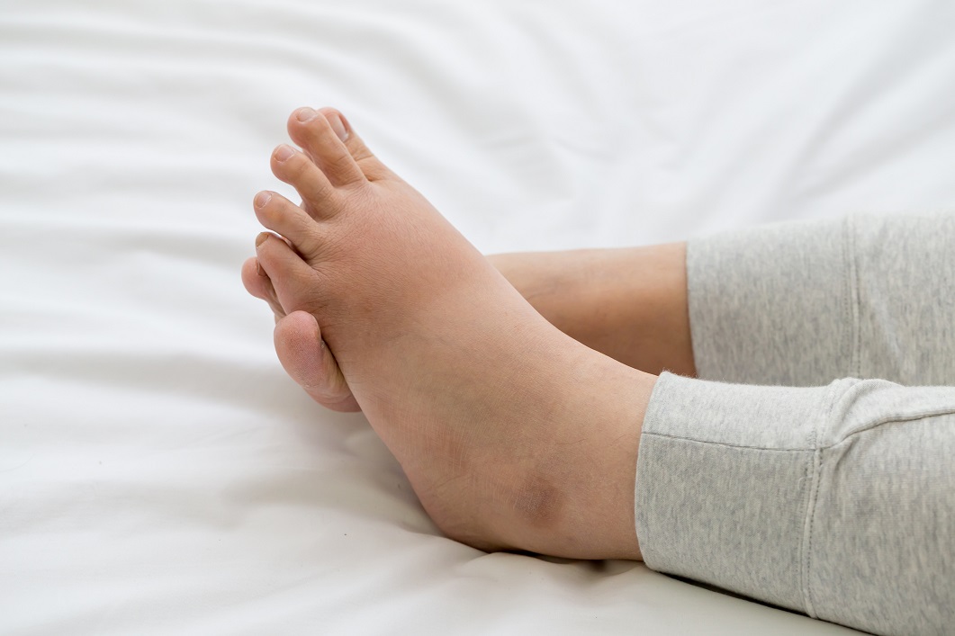 Pregnant women with swelling feet, pain foot and lying on bed in the room. Swollen feet and fetal poisoning or toxicity concept