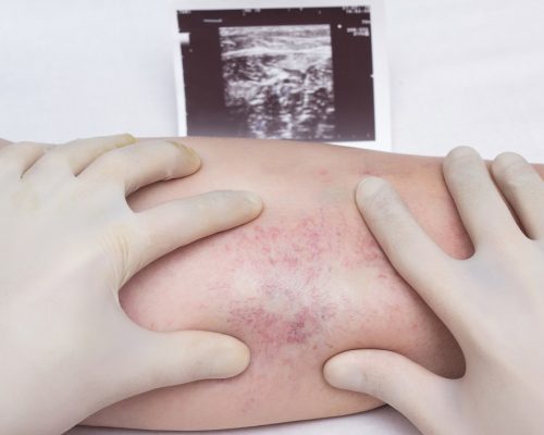 A doctor in gloves examines the veins and legs of the patient for the presence of thrombosis and varicose veins of the extremities, close-up, white background, ultrasound shot