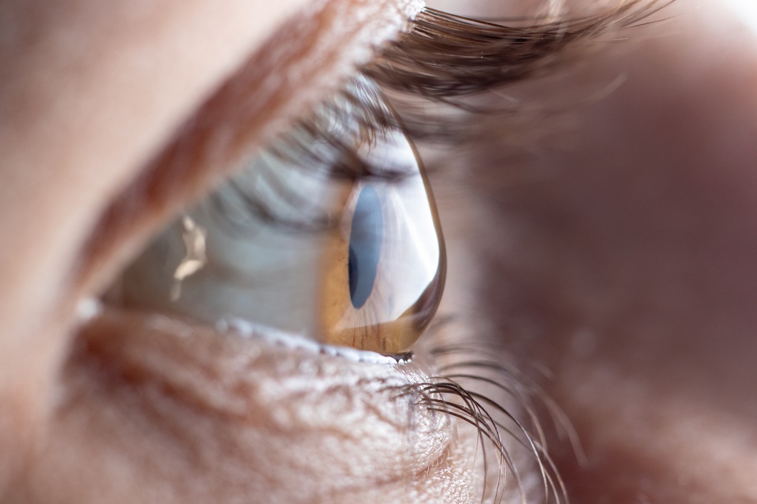 Macro eye. Ophthalmic disease - keratoconus.