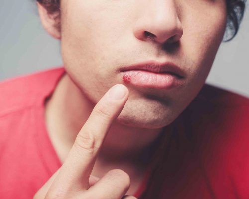 Young man is showing a cold sore on his lip