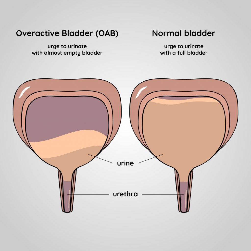 Study Links Overactive Bladder to Increased Falling Risk in Older Adults