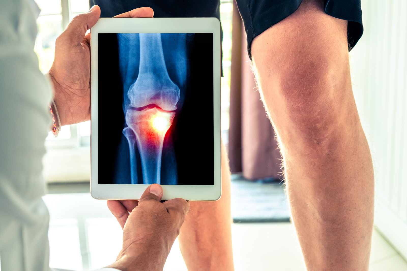 Osteoarthritis Is Becoming More ...