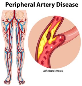 Medical peripheral artery disease illustration