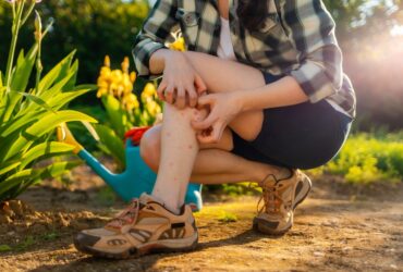 Bug Bites Are a Part of Summer, ...