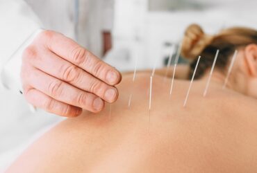 Study Finds That Acupuncture Can...