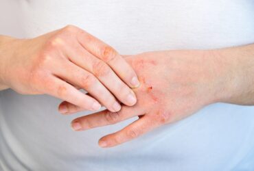 Are Your Dry Hands Really Eczema?