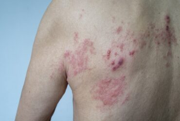 Shingles May Boost the Risk of S...